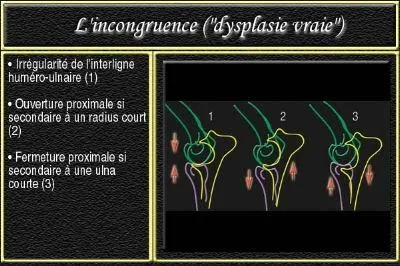Incongruence articulaire
